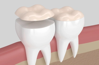 Two dental crowns illustrated on tooth models showing restorative dental procedure.