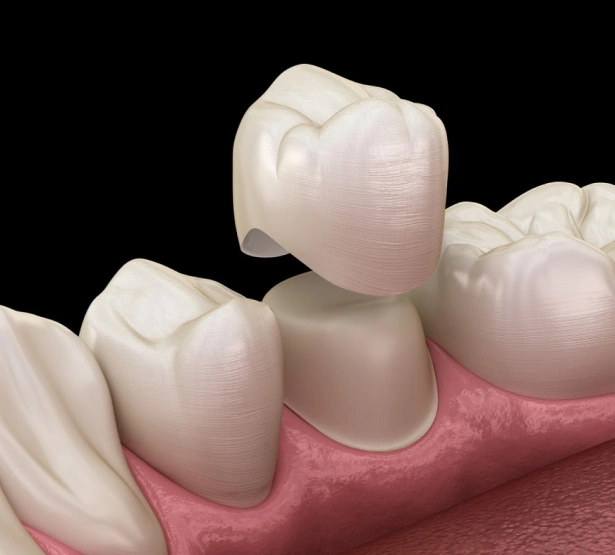 Dental crown placement on tooth model showing prosthetic restoration on pink gum tissue.