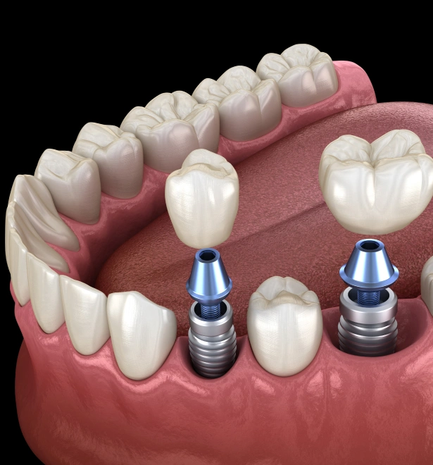 Dental implant diagram showing tooth crown placement on jaw bone with implant fixtures and abutments.