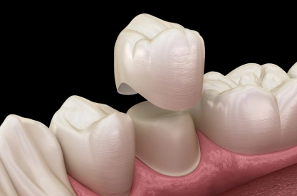 Dental crown placement illustration showing tooth preparation and ceramic crown restoration on gum model.