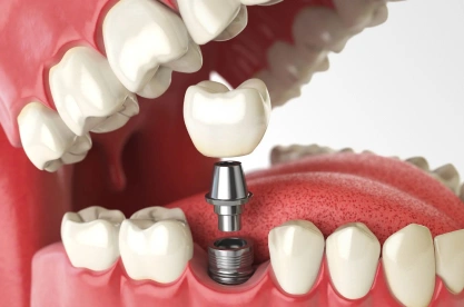 Dental implant model showing tooth replacement procedure with crown and metal post on gum model.