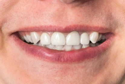 Close-up of a person's smile showing white, healthy teeth and natural lips.