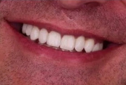 Close-up of a person's smile showing white, healthy teeth and lips.