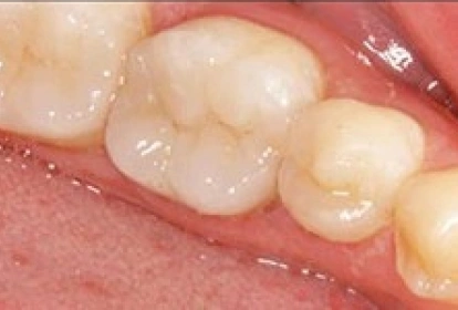 Close-up view of restored teeth showing dental crowns and fillings in a clinical setting.