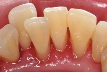 Close-up view of natural-looking dental crowns on upper front teeth in mouth.