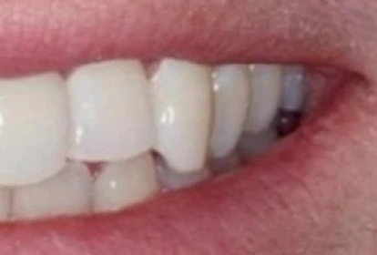 Close-up of dental veneers showing natural-looking tooth shade progression on patient smile.