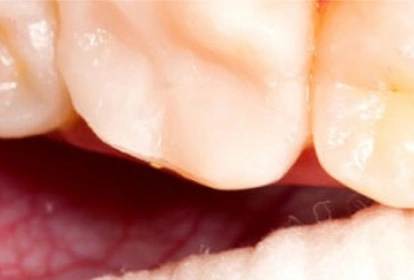 Close-up of upper front teeth and gums showing dental health examination in clinical setting.