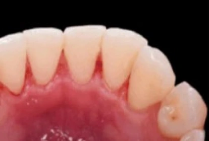 Close-up of inflamed gums showing gum recession and dental health issues requiring treatment.