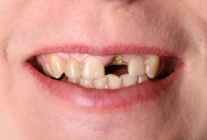 Close-up of smile showing missing tooth and dental issues requiring professional care.