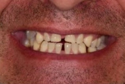 Close-up of a patient's smile showing discolored and misaligned teeth before dental treatment.