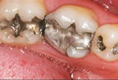 Severely decayed molars with dark cavities in upper teeth showing advanced dental disease.