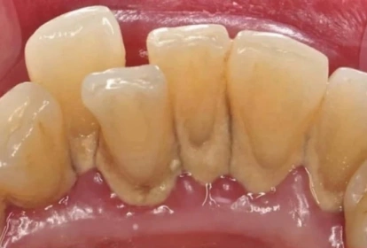 Dental crowns displayed on model gums showing tooth-colored restorative dentistry options.