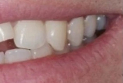 Close-up of upper teeth showing dental veneers or crowns in varying shades during cosmetic dental treatment.