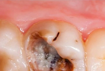 Close-up dental view showing tooth decay and cavity requiring professional treatment.