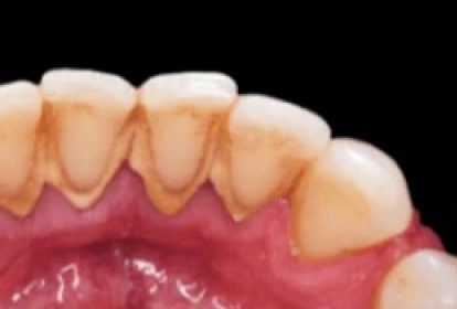 Close-up of teeth and gums showing gum recession and tooth wear, dental health illustration.