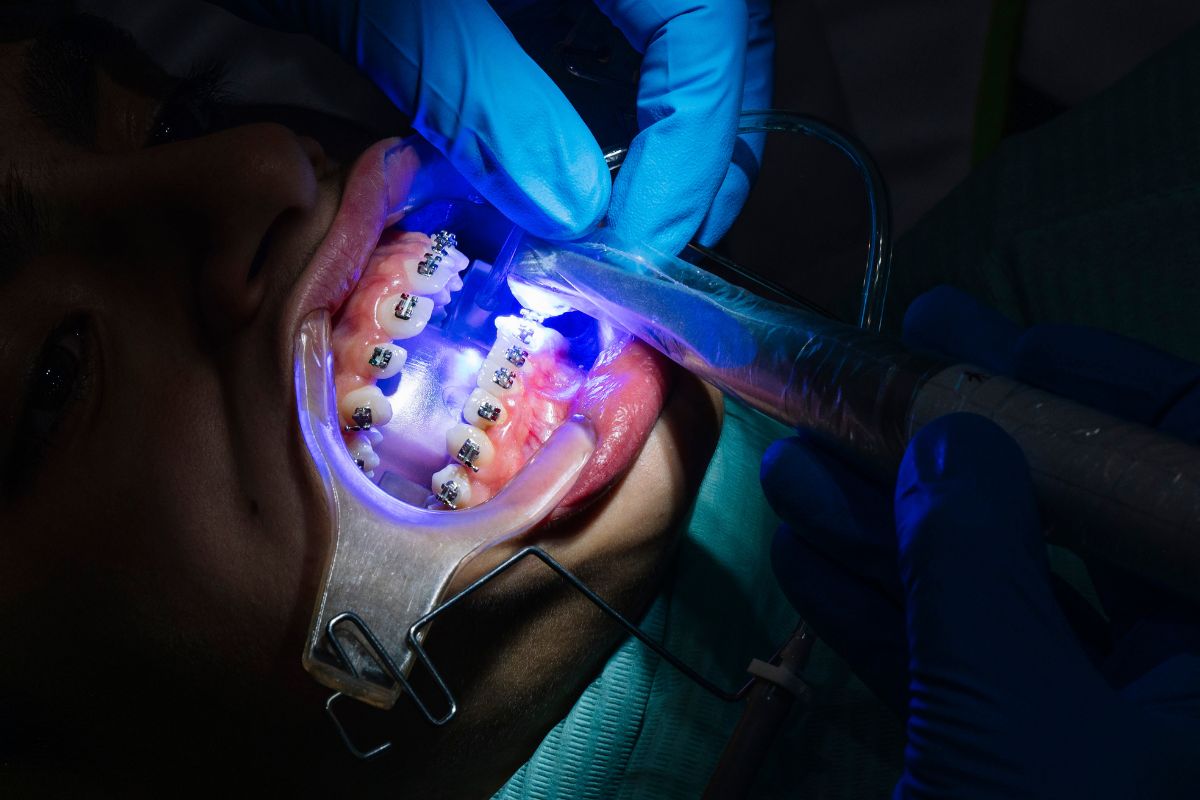 How Long Does Full Mouth Rehabilitation Take?