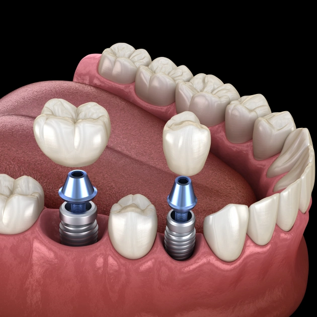 How Long Does a Dental Crown Last