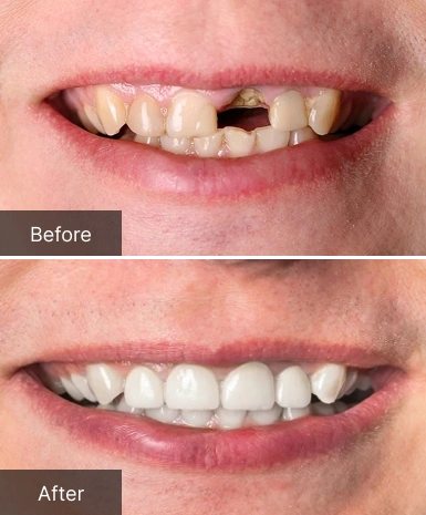 Before and after dental treatment showing tooth restoration and whitening results at Dr. Bob's Dental Care.