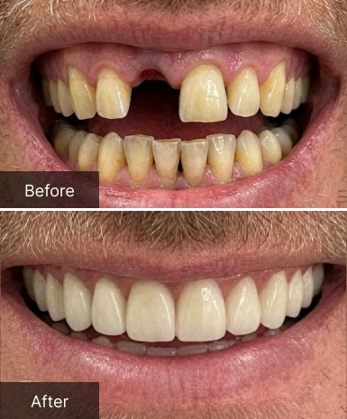 Before and after dental transformation showing yellowed, gapped teeth versus bright, aligned smile.