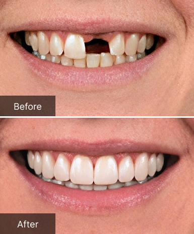 Before and after dental treatment showing improved tooth alignment and whitening at Dr. Bob's Dental Care.