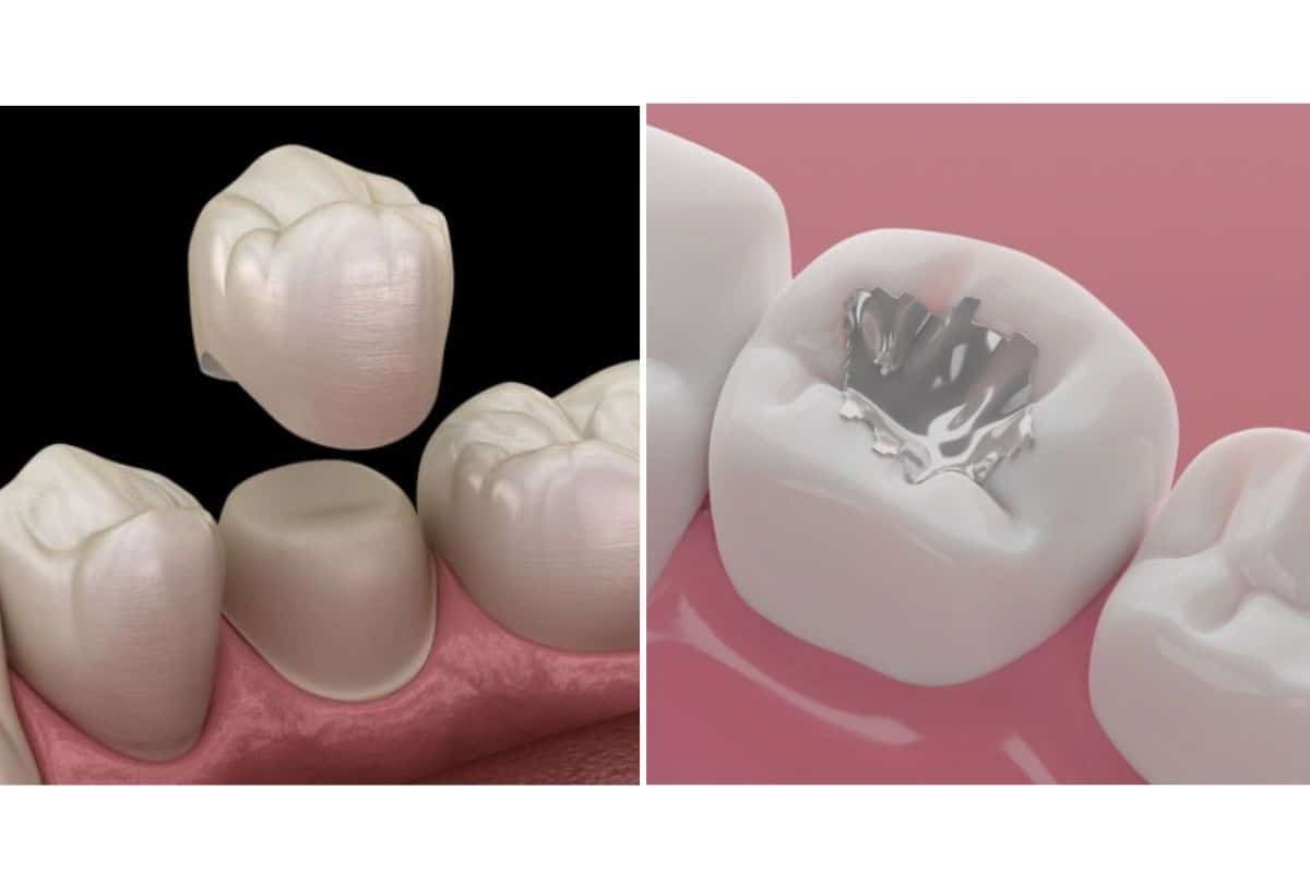 3D illustration comparing dental crown and filling procedures on teeth.
